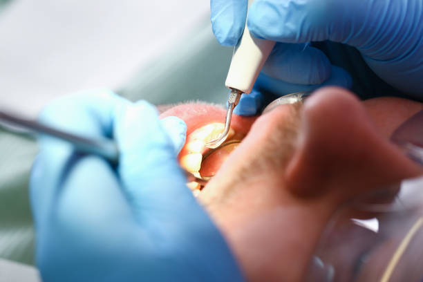 Best Knocked-Out Tooth (Avulsed Tooth) Treatment in Meridianville, AL